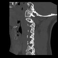 Clay-shoveler fracture (Radiopaedia 22568-22590 Sagittal bone window 34).jpg
