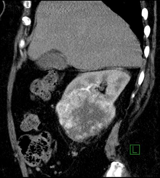 File:Clear cell renal cell carcinoma (Radiopaedia 85004-100537 D 46).jpg