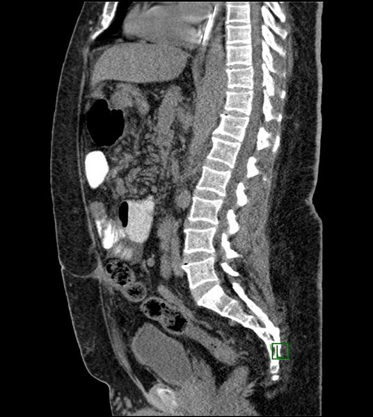 File:Closed-loop small bowel obstruction-internal hernia (Radiopaedia 78439-91096 C 75).jpg