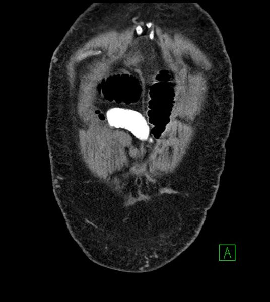 File:Closed-loop small bowel obstruction-internal hernia (Radiopaedia 78439-91096 Coronal non-contrast 18).jpg