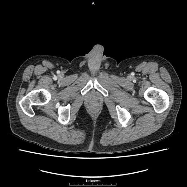 File:Closed loop bowel obstruction and ischemia (Radiopaedia 86959-103180 A 94).jpg