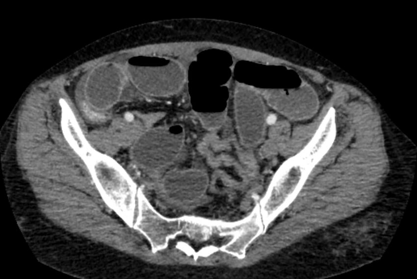 Closed loop small bowel obstruction (Radiopaedia 71211-81508 A 127).jpg