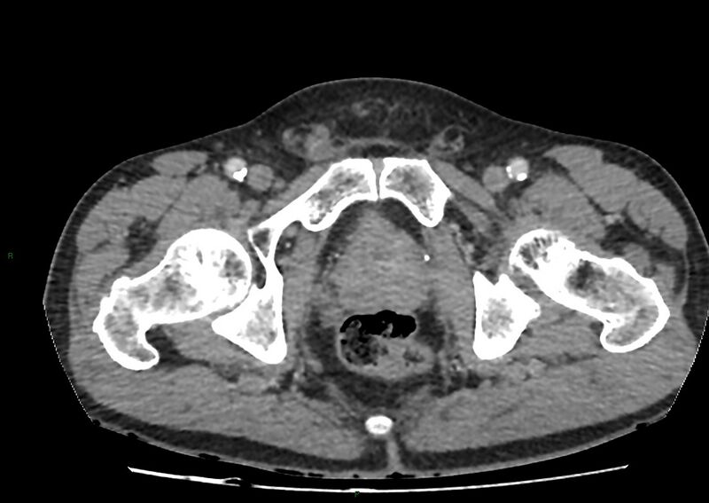 File:Closed loop small bowel obstruction with ischemia (Radiopaedia 84180-99456 A 119).jpg