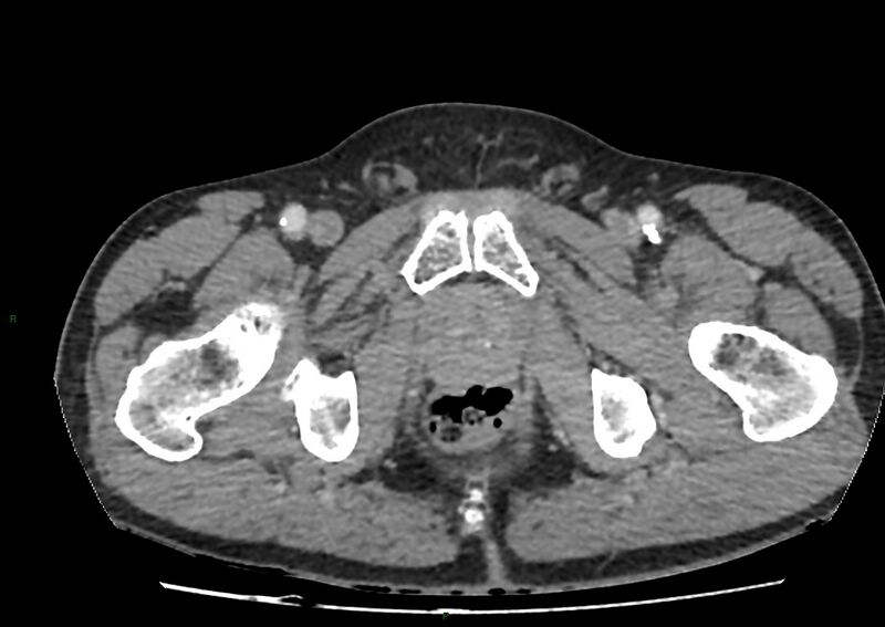 File:Closed loop small bowel obstruction with ischemia (Radiopaedia 84180-99456 A 122).jpg