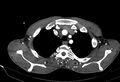 Coarctation of aorta with aortic valve stenosis (Radiopaedia 70463-80574 A 9).jpg