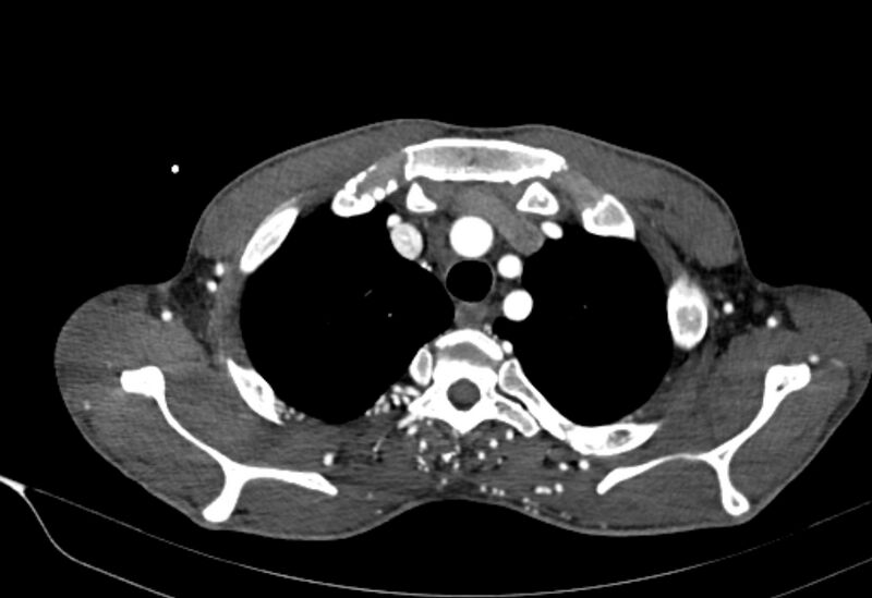 File:Coarctation of aorta with aortic valve stenosis (Radiopaedia 70463-80574 A 9).jpg