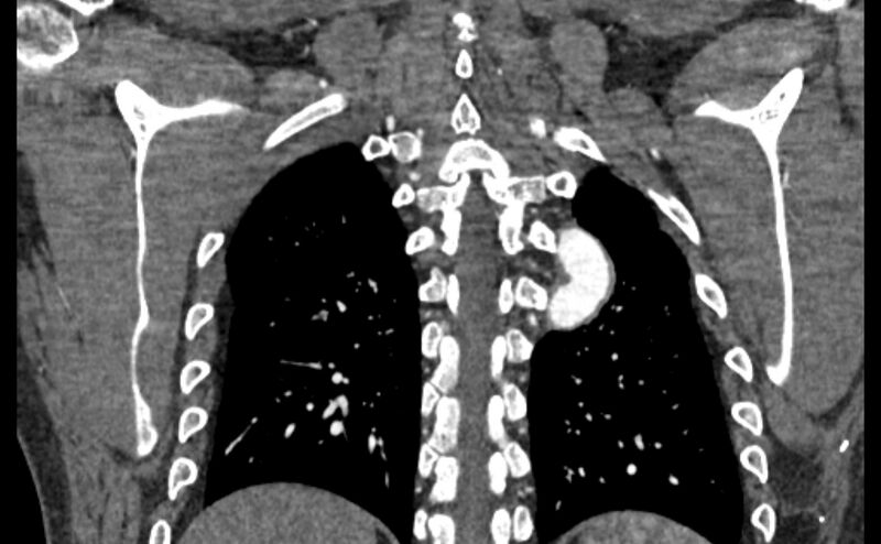 File:Coarctation of the aorta (Radiopaedia 53363-59343 C 55).jpg