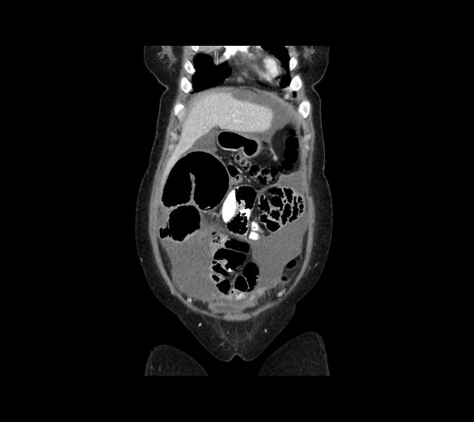 File:Cocoon abdomen with possible tubo-ovarian abscess (Radiopaedia 46235-50636 B 10).jpg