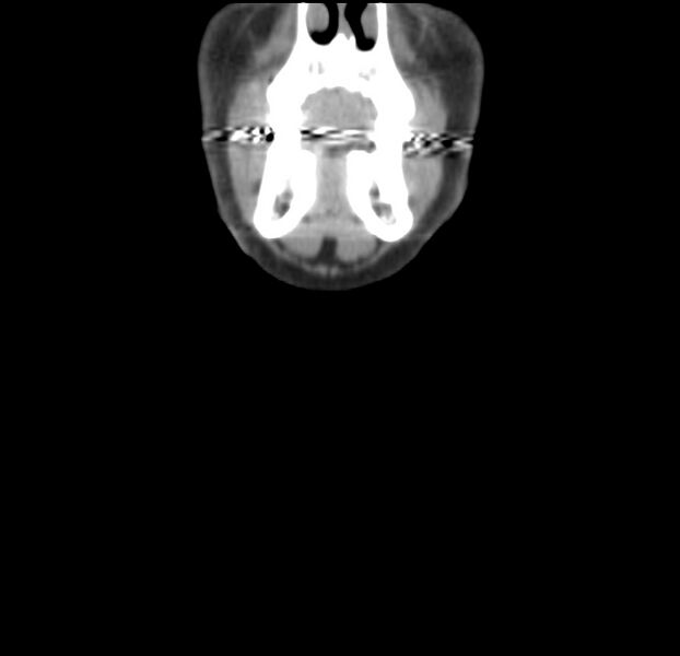 File:Colloid cyst of thyroid (Radiopaedia 22897-22923 Coronal C+ delayed 5).jpg