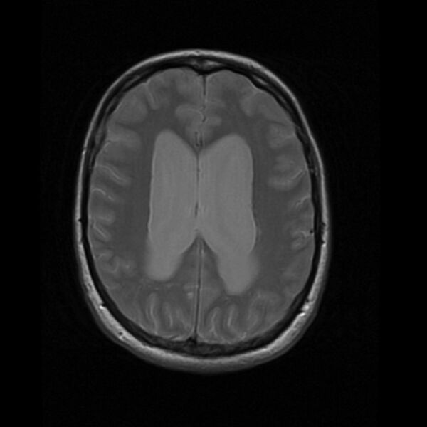 File:Colloid cyst with hydrocephalus (Radiopaedia 9373-10065 Axial PD 13).jpg