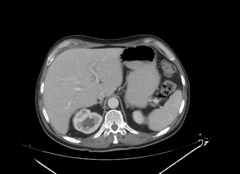 File:Colon cancer mimicking renal cell carcinoma (Radiopaedia 28986-29335 C 16).jpg
