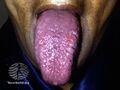 Macroglossia due to systemic amyloidosis (DermNet NZ systemic-amyloid6).jpg