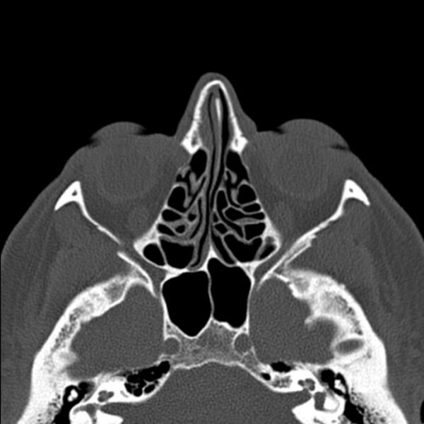 File:Nasal septal perforation (Radiopaedia 25030-25289 Axial bone window 32).jpg