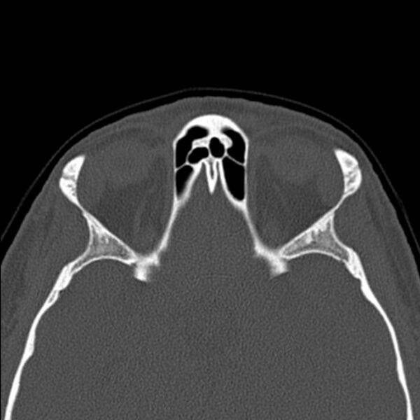 File:Nasal septal perforation (Radiopaedia 25030-25289 Axial bone window 51).jpg