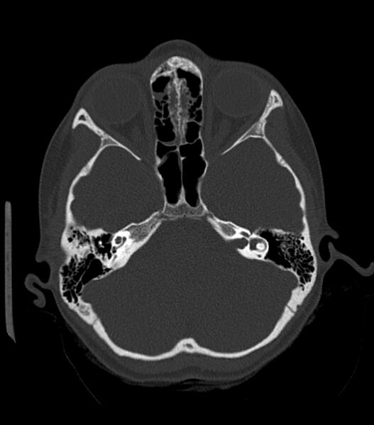 File:Nasoorbitoethmoid fracture (Radiopaedia 90044-107205 Axial bone window 82).jpg