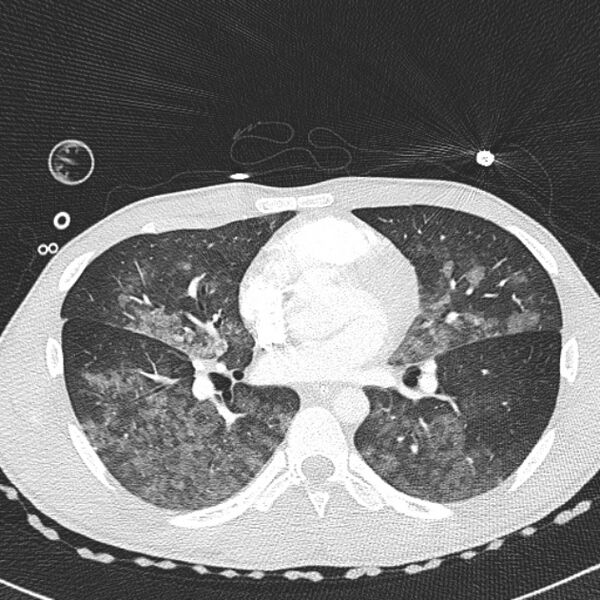 File:Near drowning (pulmonary edema) (Radiopaedia 24685-24958 lung window 36).jpg