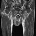 Necrotizing epididymo-orchitis with intra-testicular abscess (Radiopaedia 29397-29860 Coronal T1 C+ 9).jpg
