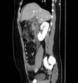 Necrotizing pancreatitis (Radiopaedia 23001-23031 C 23).jpg
