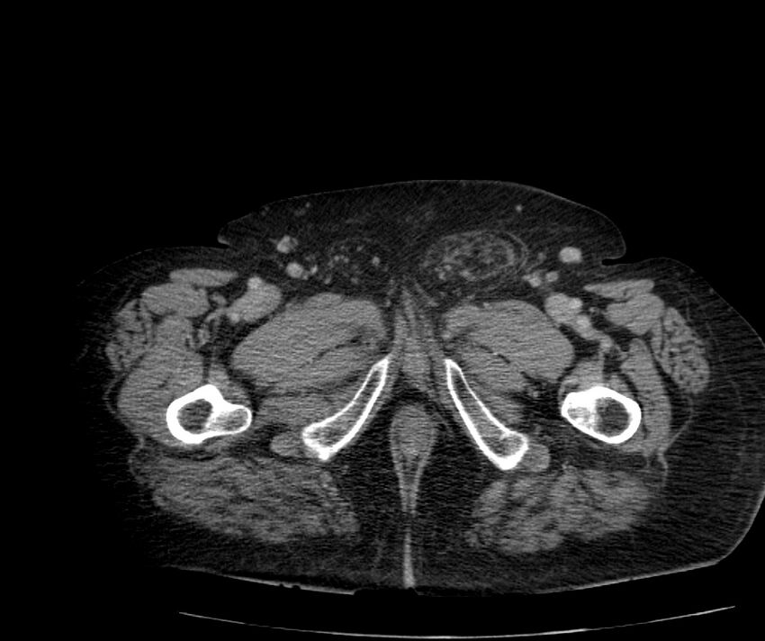 Nephroptosis with inguinal hernia containing perirenal fat (Radiopaedia 56632-63391 C 352).jpg