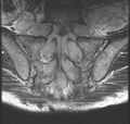 Neurofibromatosis type 1 (Radiopaedia 11671-12034 Coronal T2 1).jpg