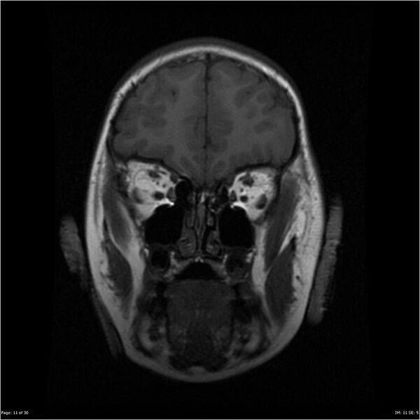 File:Neurofibromatosis type 1 (Radiopaedia 22541-22564 Coronal T1 20).jpg