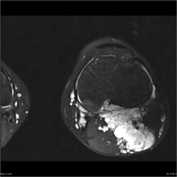 File:Neurofibromatosis type 1 (Radiopaedia 22541-22566 D 17).jpg