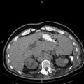 Non Hodgkin lymphoma in a patient with ankylosing spondylitis (Radiopaedia 84323-99621 Axial non-contrast 30).jpg