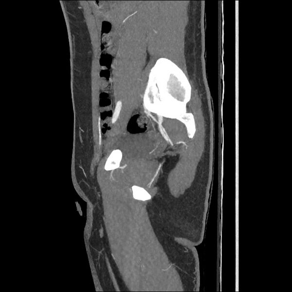 File:Normal CT angiogram of pelvis (Radiopaedia 45390-49430 C 46).jpg