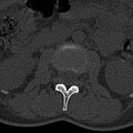 Normal CT lumbar spine (Radiopaedia 53981-60118 Axial bone window 28).jpg