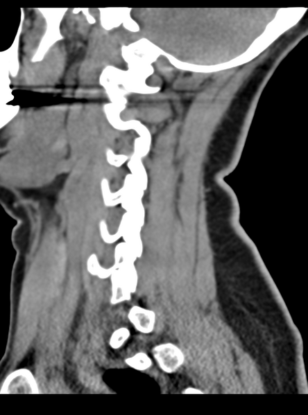 File:Normal cervical spine MRI (including Dixon) (Radiopaedia 42762-45926 C 16).png