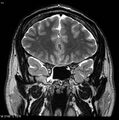 Normal coronal brain (Radiopaedia 6676-7910 Coronal T2 11).jpg