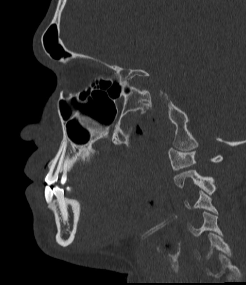 Normal facial bone CT (Radiopaedia 88742-105476 Sagittal bone window 72).jpg