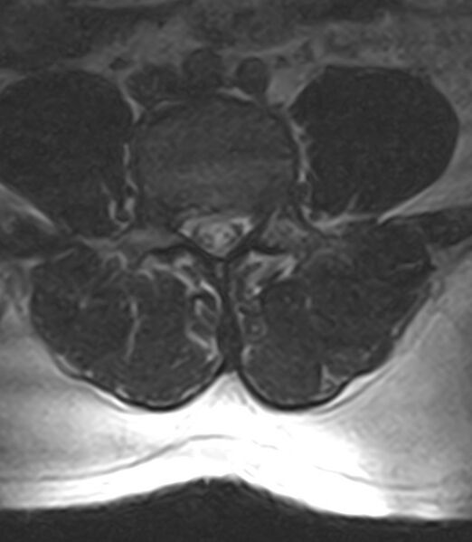 File:Normal lumbar spine MRI - low-field MRI scanner (Radiopaedia 40976-43699 Axial T2 68).jpg