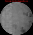 Normal retrograde pyelography of a native and transplant kidney (Radiopaedia 40480-43054 Transplant kidney 3).jpg