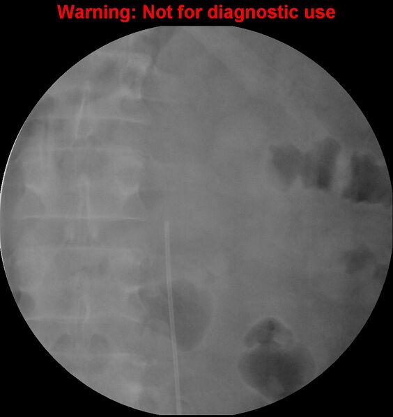 File:Normal retrograde pyelography of a native and transplant kidney (Radiopaedia 40480-43054 Transplant kidney 3).jpg