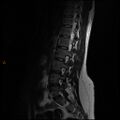 Normal spine MRI (Radiopaedia 77323-89408 Sagittal T2 5).jpg