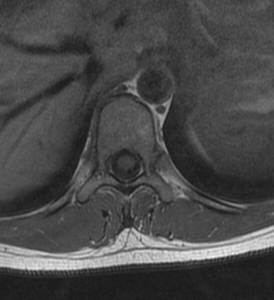 File:Normal thoracic spine MRI (Radiopaedia 41033-43781 Axial T1 16).jpg