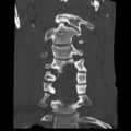 Normal trauma cervical spine (Radiopaedia 41017-43760 Coronal bone window 15).png