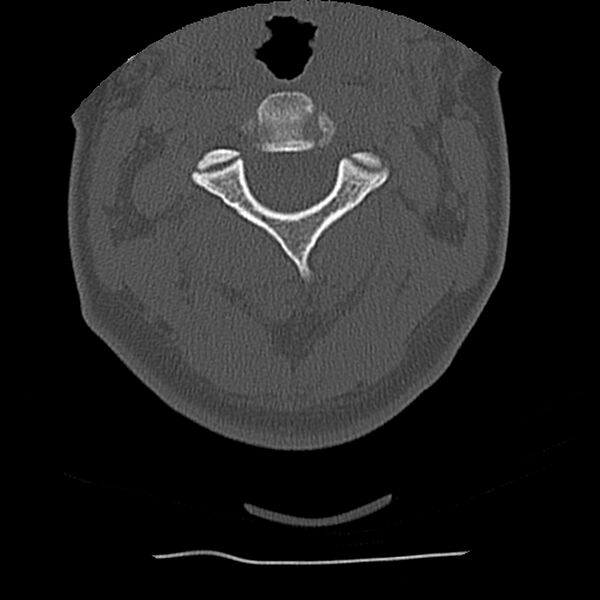 File:Normal trauma spine imaging (Radiopaedia 31753-32686 Axial bone window 23).jpg