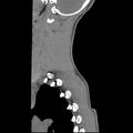 Normal trauma spine imaging (age 16) (Radiopaedia 45335-49358 C 3).jpg