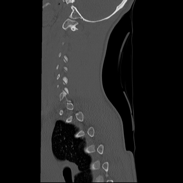 File:Normal trauma spine imaging (age 16) (Radiopaedia 45335-49358 Sagittal bone window 7).jpg