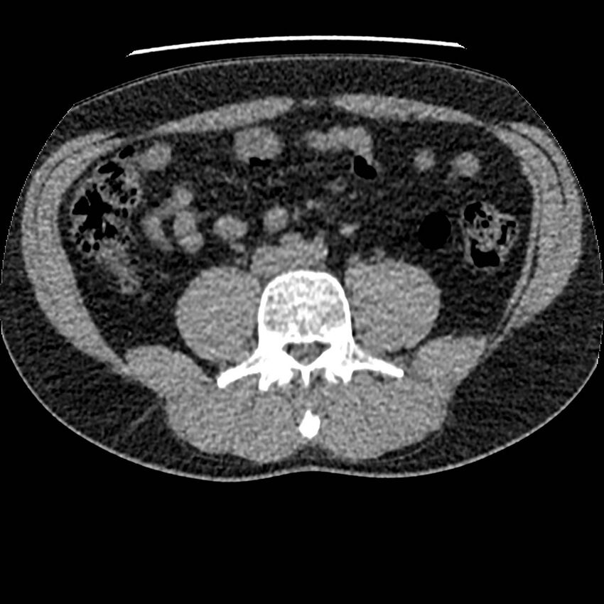Obstructing ureteric calculus and ureteric anatomy (Radiopaedia 62730-71042 Axial non-contrast 82).jpg
