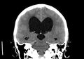 Obstructive hydrocephalus (Radiopaedia 30453-31119 Coronal non-contrast 23).jpg