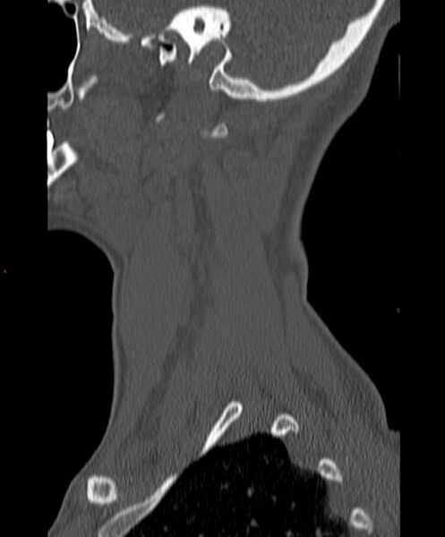 File:Occipital condyle fracture (Radiopaedia 61165-69056 Sagittal bone window 4).jpg