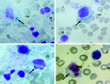 Peripheral blood smears shows variable-sized basophilic inclusions in mononuclear cells from child with human monocytic ehrlichiosis