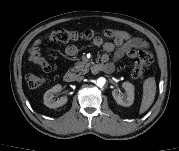 File:Abdominal aortic aneurysm (Radiopaedia 22421-22458 C+ arterial phase 30).jpg