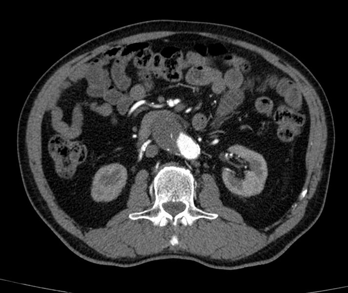 File:Abdominal aortic aneurysm (Radiopaedia 22421-22458 C+ arterial phase 37).jpg