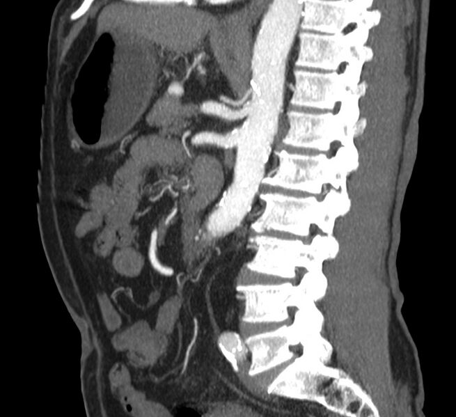 File:Abdominal aortic aneurysm (Radiopaedia 22421-22458 D 24).jpg
