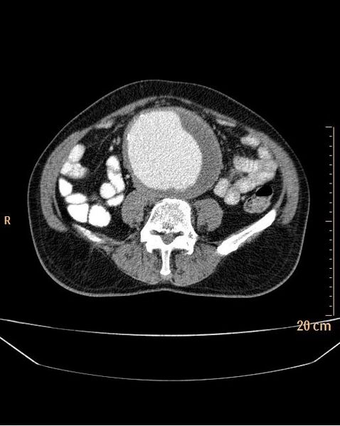 File:Abdominal aortic aneurysm (Radiopaedia 25985-26121 Axial C+ arterial phase 23).jpg