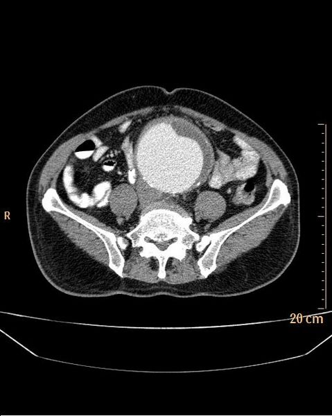 File:Abdominal aortic aneurysm (Radiopaedia 25985-26121 Axial C+ arterial phase 27).jpg
